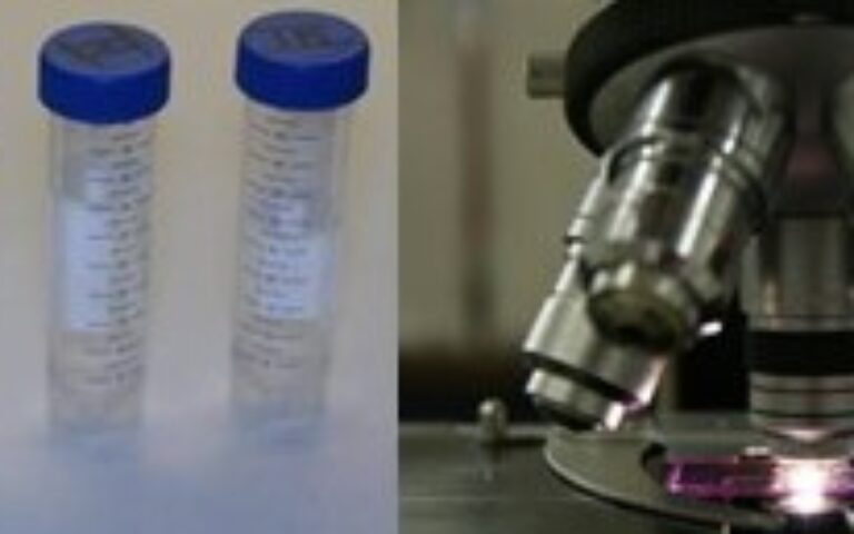 Bronchoalveolar lavage in the work-up of interstitial lung diseases