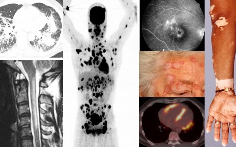CME-Online nascholing huisartsen: ‘Sarcoïdose: een klinische uitdaging’