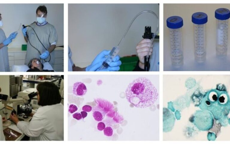 Broncho Alveolar Lavage (BAL) in de workup of ILD and infectious lung diseases