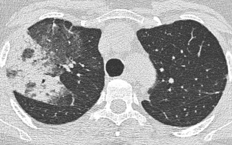 Cryptogene organiserende pneumonie (COP)
