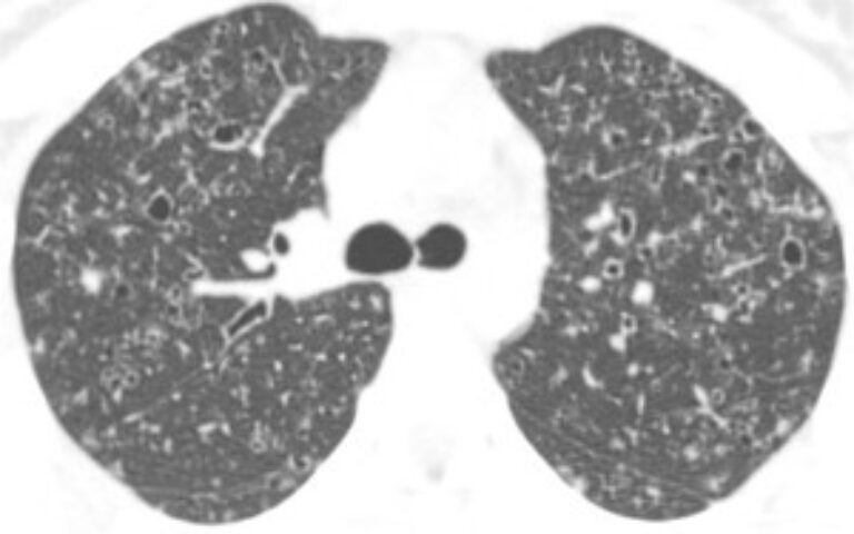 Pulmonale Langerhanscel Histiocytose (PLCH)